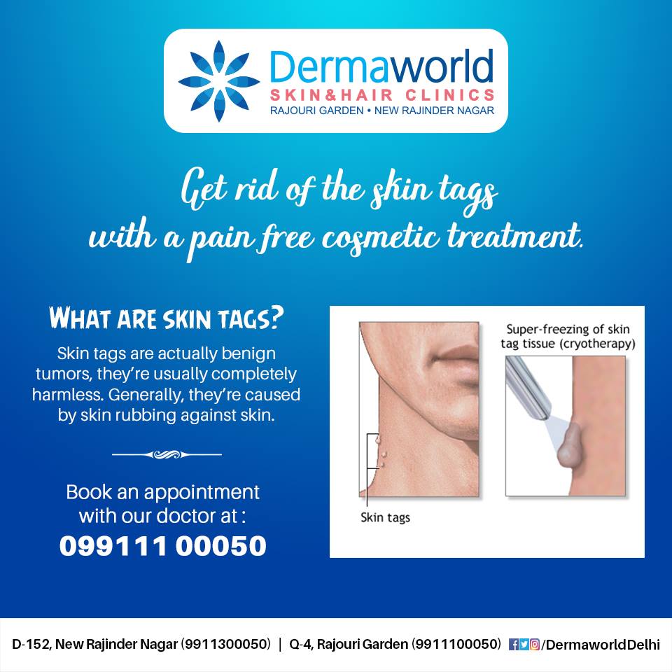 Get rid of the skin tags with a pain free cosmetic treatment.