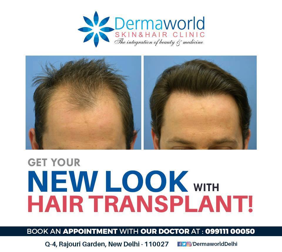 Get a new and fresh look with the Hair Transplant at Dermaworld Skin And Hair Clinics. 
