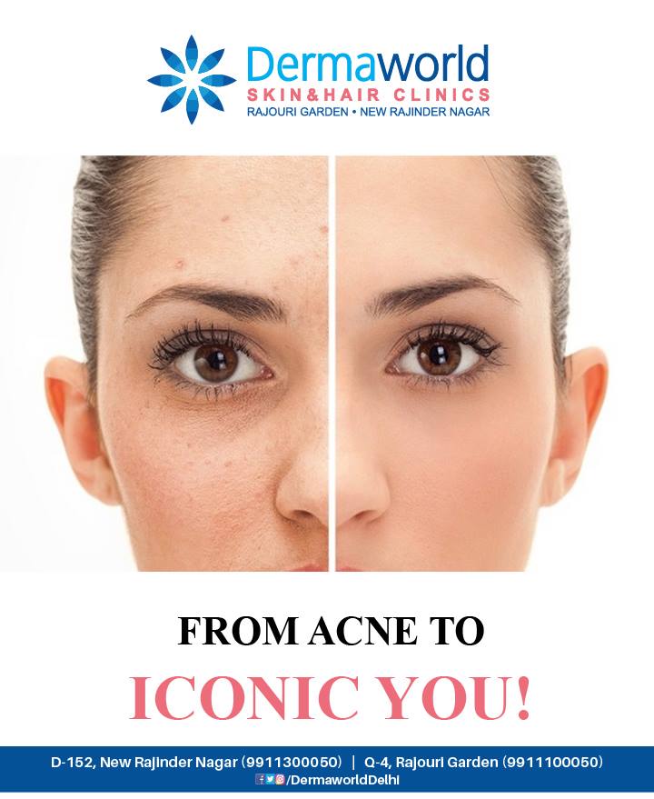 Best Skin specialist in Delhi for acne