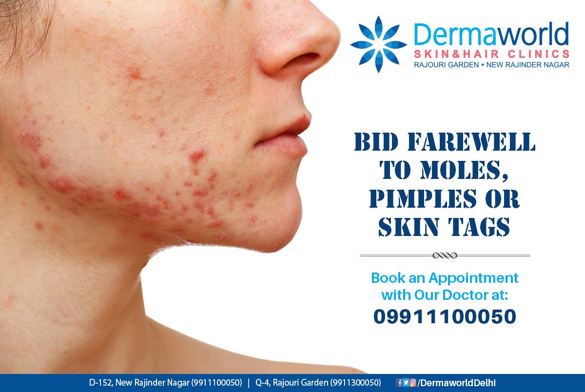 best pimple treatment in delhi