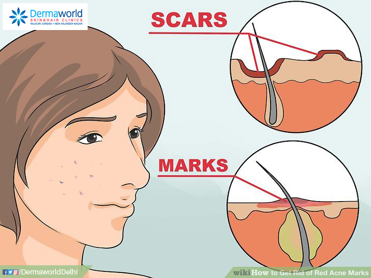 Difference between Acne Marks and Acne Scars