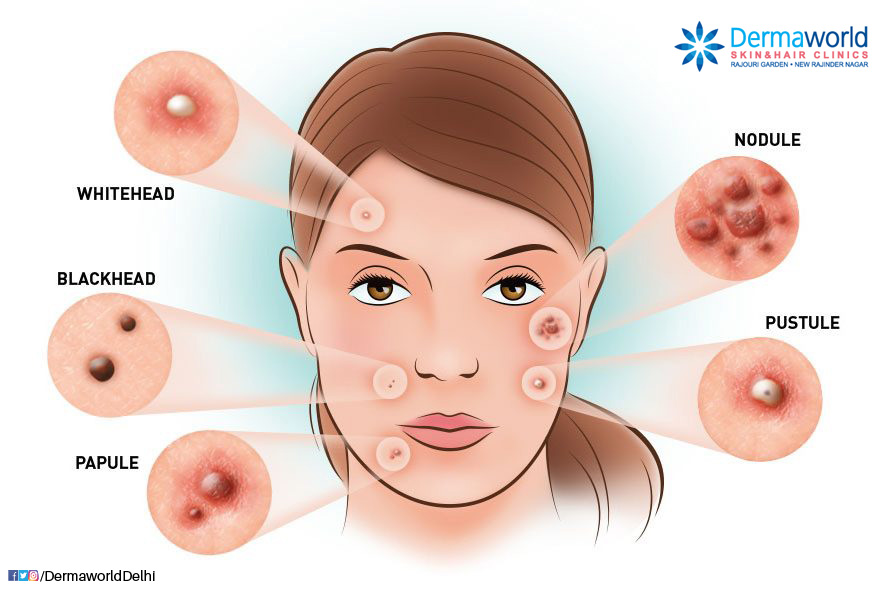 Acne: papules, pustules, cysts etc