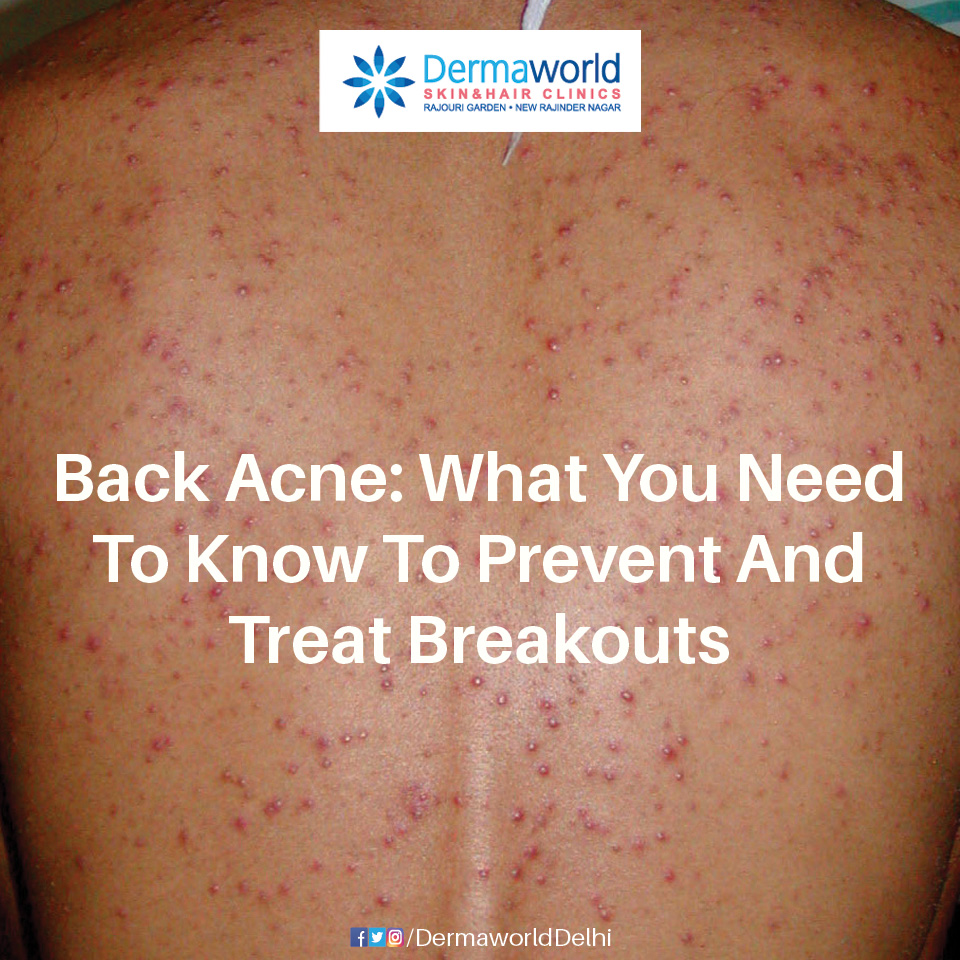 BACK ACNE - Causes and Cure