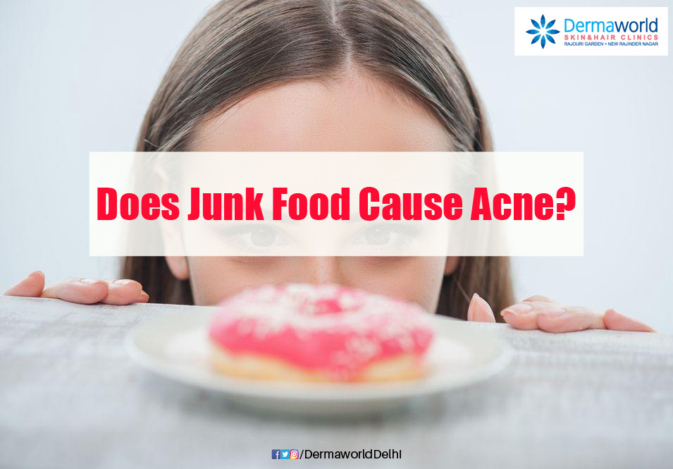 Does Junk Food cause ACNE??