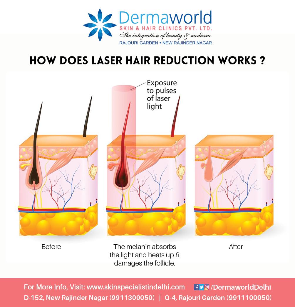 Laser hair reduction treatment