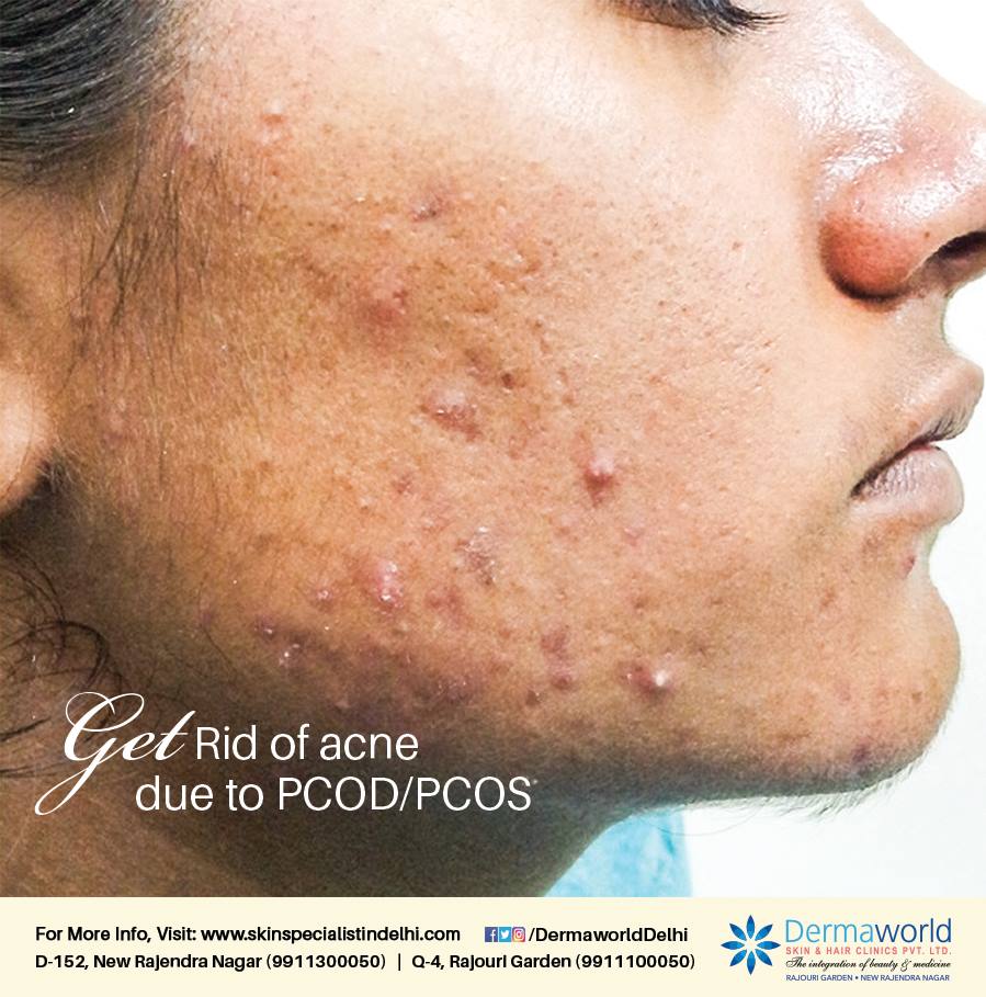 Acne Treatment in Delhi