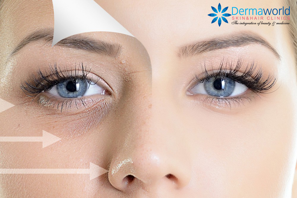 Use of derma fillers under dark eye