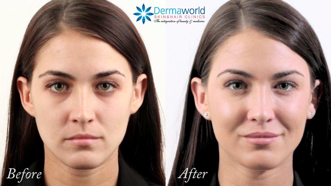 Dermal Fillers for Cheeks