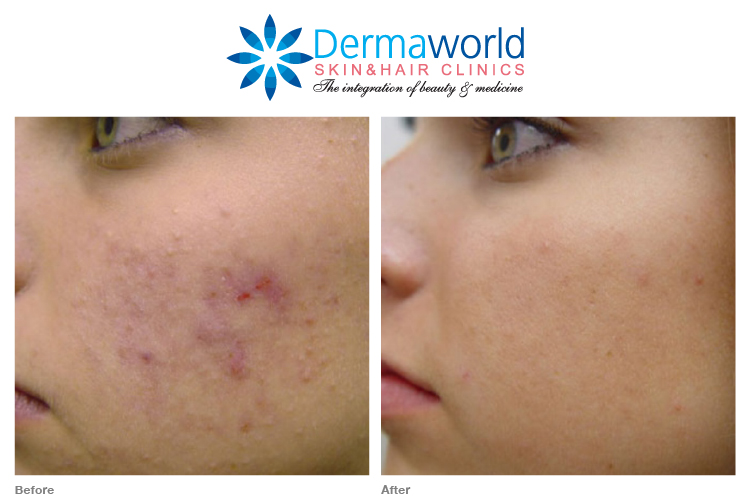 Dermal fillers for acne scars