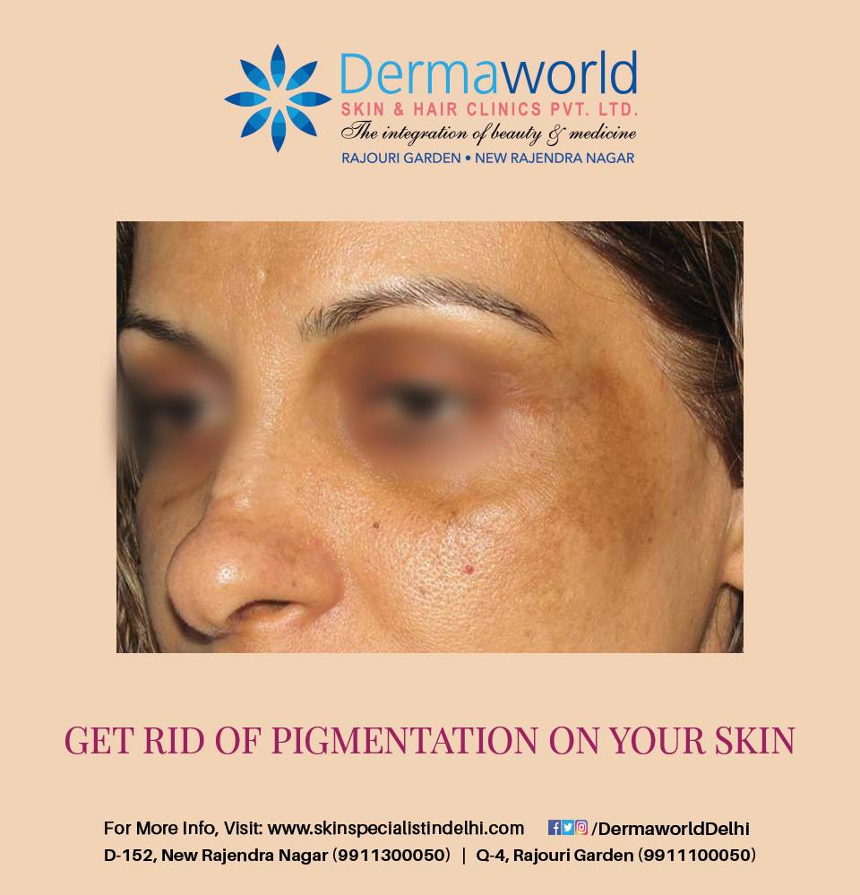 Best pigmentation treatment in Delhi
