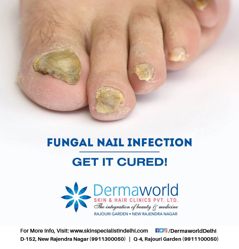 Fungal infection treatment 