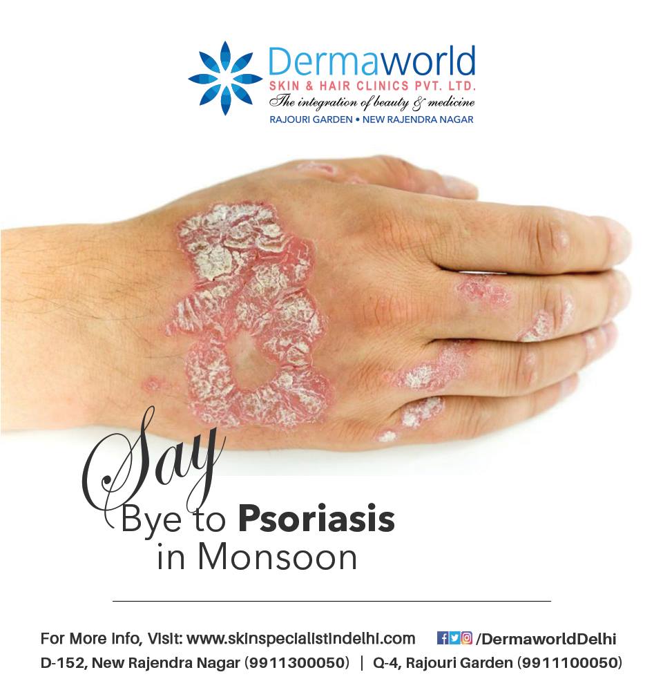 Best skin specialist for psoriasis treatment