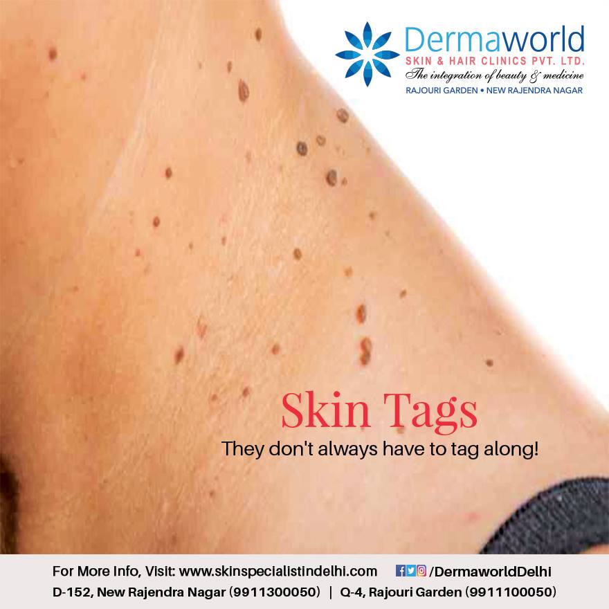 best skin tag removal treatment