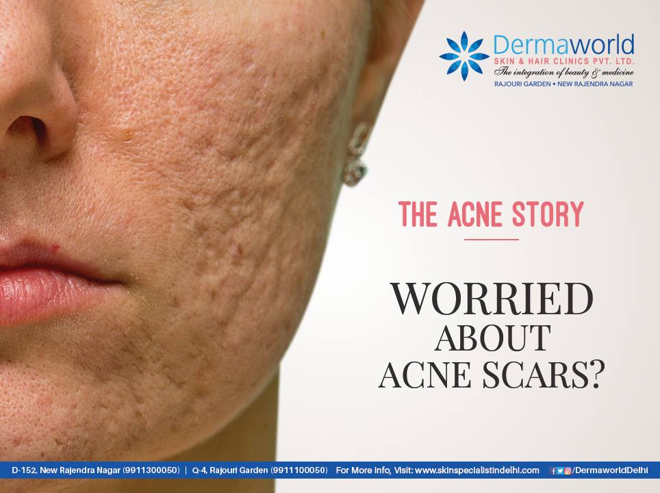 Best acne treatment in Delhi