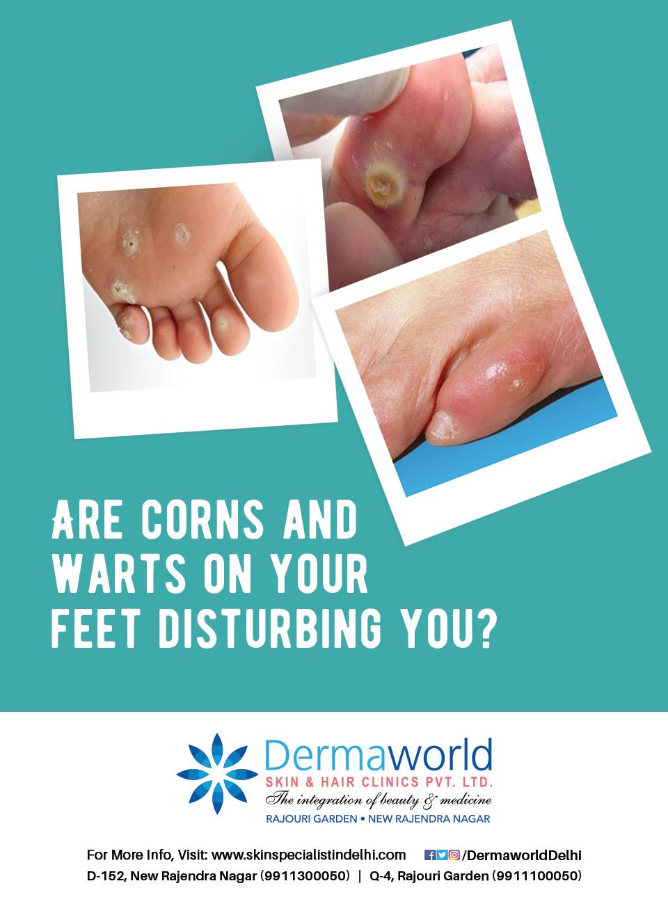 Best treatment for warts & corns