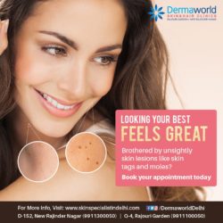 Get rid of skin tags, lesions and warts