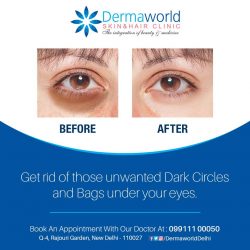 Under eye dark circle treatment in delhi