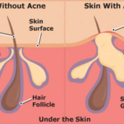What causes Acne? Whats the difference in a normal Skin and a Skin with Acne?
