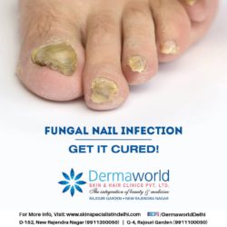 Fungal infection treatment