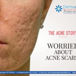 Best acne treatment in Delhi
