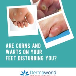 Best treatment for warts & corns